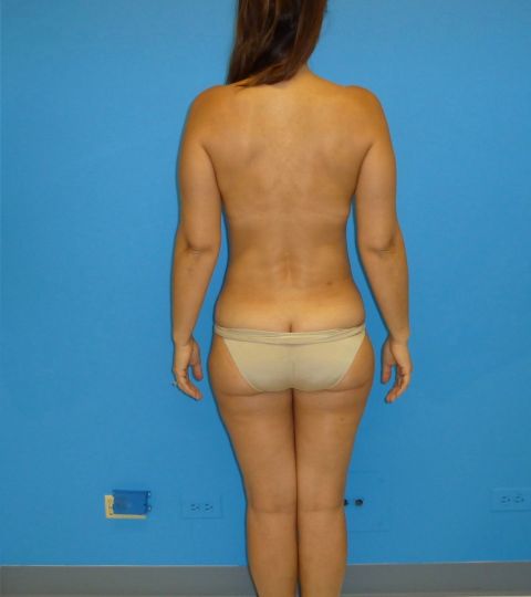 after liposuction female patient back view case 2412