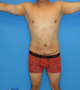 after liposuction male patient front view case 2407