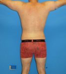 after liposuction male patient back view case 2407