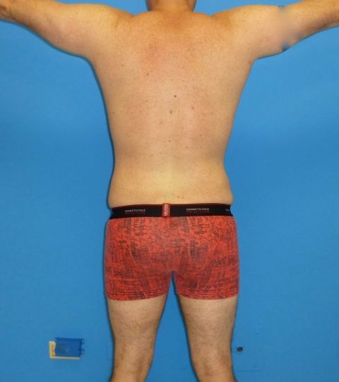 after liposuction male patient back view case 2407