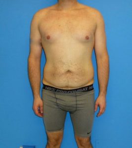 before liposuction male patient front view case 2407