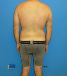 before liposuction male patient back view case 2407