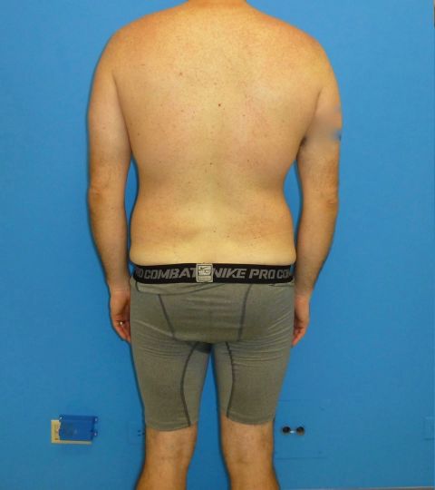 before liposuction male patient back view case 2407