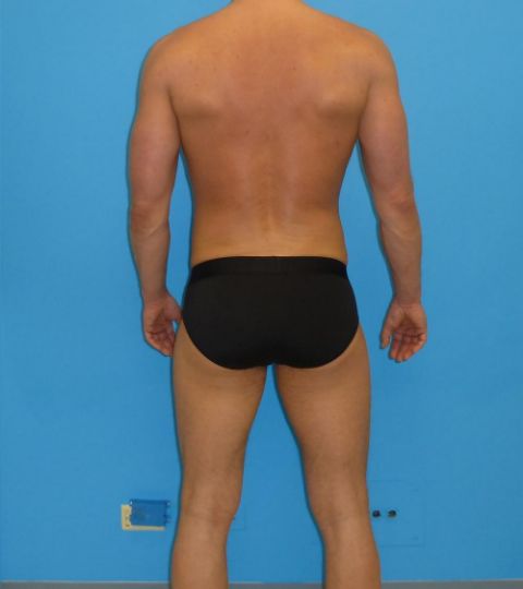 after liposuction male patient back view case 2163