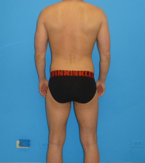 before liposuction male patient back view case 2163