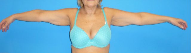 before arm liposuction female patient with arms held straight out front view case 2803