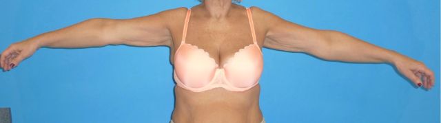 after arm liposuction female patient with arms held straight out front view case 2803