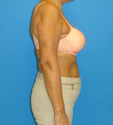 after arm liposuction female patient right side view case 2803