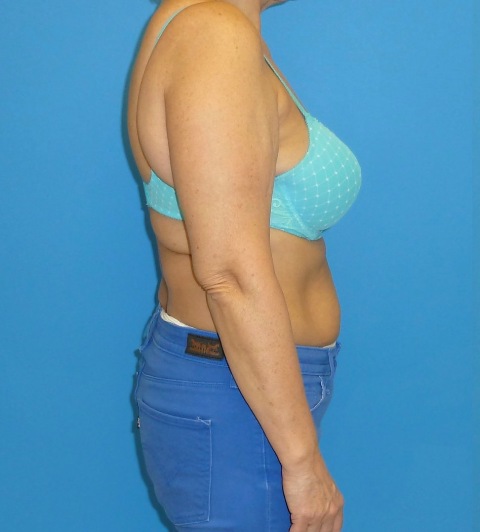 before arm liposuction female patient right side view case 2803