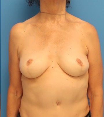 after breast implant removal front view case 2618