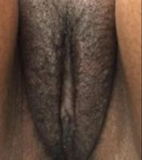 after labiaplasty front view case 2745