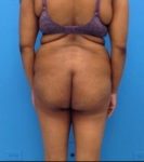 before liposuction female patient back view case 2283
