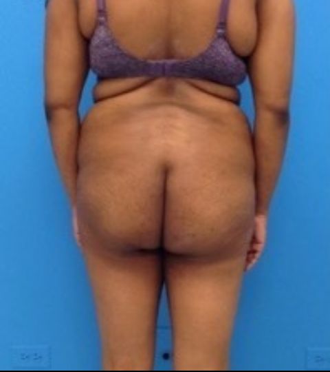 before liposuction female patient back view case 2283