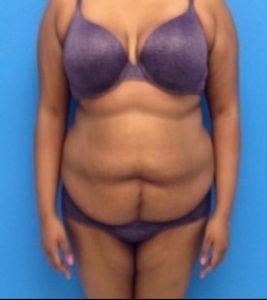 before liposuction female patient front view case 2283