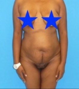 after liposuction female patient front view case 2283