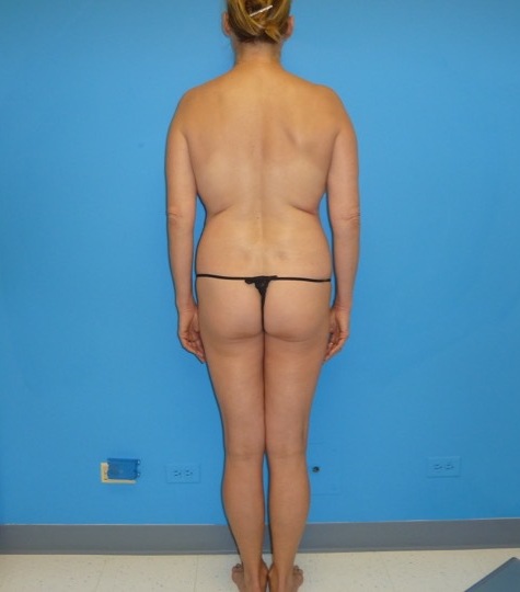 before liposuction female patient back view case 2748