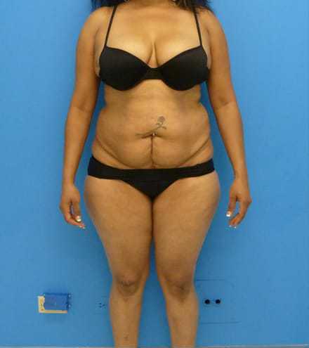 before liposuction female patient front view case 2753
