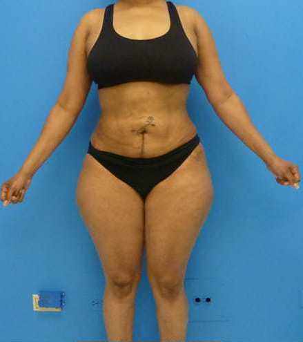 after liposuction female patient front view case 2753