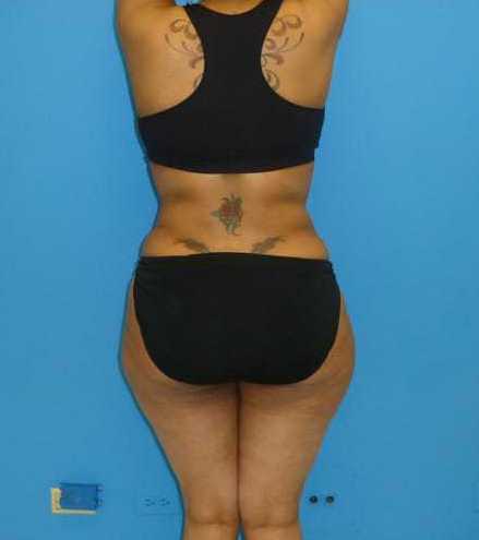 after liposuction female patient back view case 2753