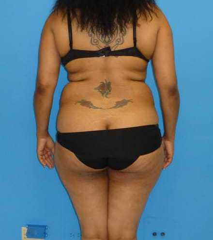 before liposuction female patient back view case 2753