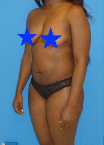before liposuction female patient left angle view case 2288