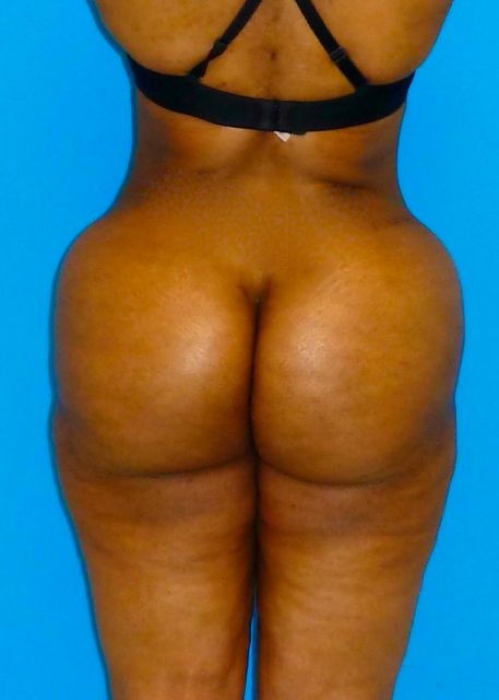 after Brazilian butt lift female patient back view case 2315