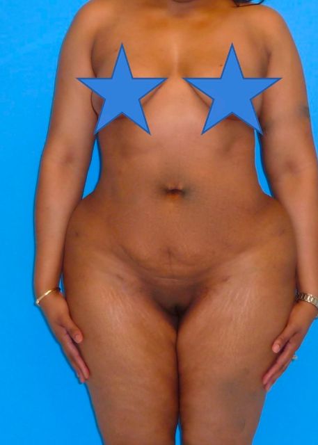after Brazilian butt lift female patient front view case 2315