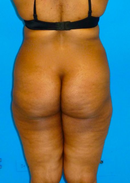 before Brazilian butt lift female patient back view case 2315