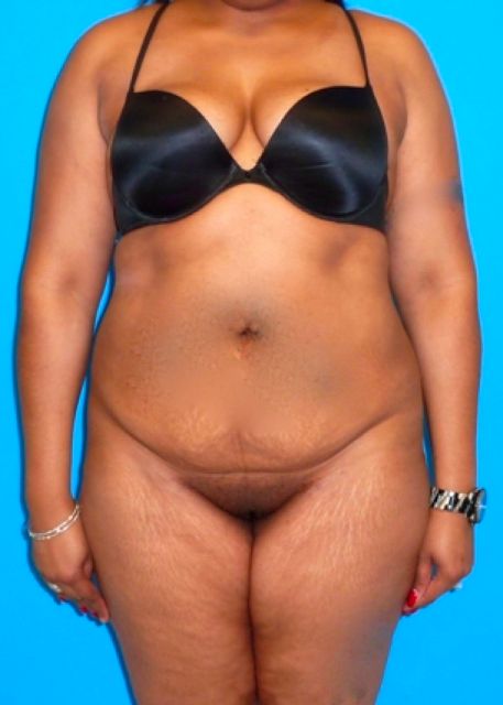 before Brazilian butt lift female patient front view case 2315
