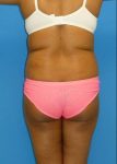 before Brazilian butt lift female patient back view case 2867