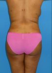 after Brazilian butt lift female patient back view case 2867