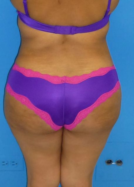 after Brazilian butt lift female patient back view case 2870