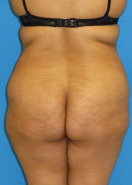 before Brazilian butt lift female patient back view case 2870