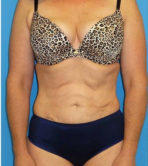 after liposuction female patient front view case 2873