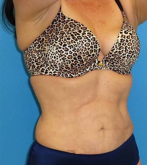 after liposuction female patient right angle view case 2873