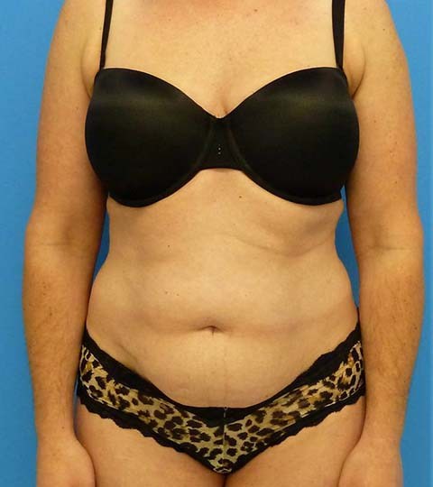 before liposuction female patient front view case 2873