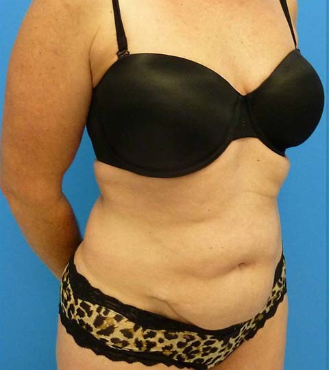 before liposuction female patient right angle view case 2873