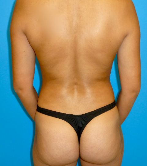 after mommy makeover back view case 2886