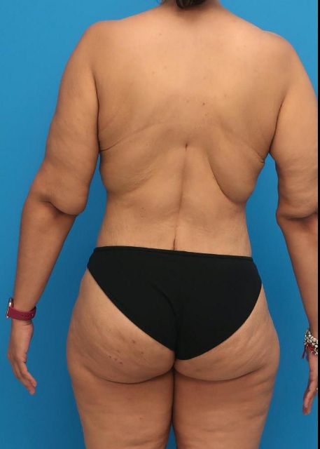after Brazilian butt lift female patient back view case 3053