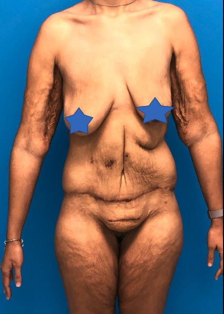 before Brazilian butt lift female patient front view case 3053