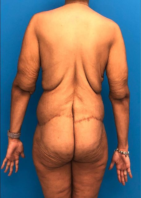 before Brazilian butt lift female patient back view case 3053