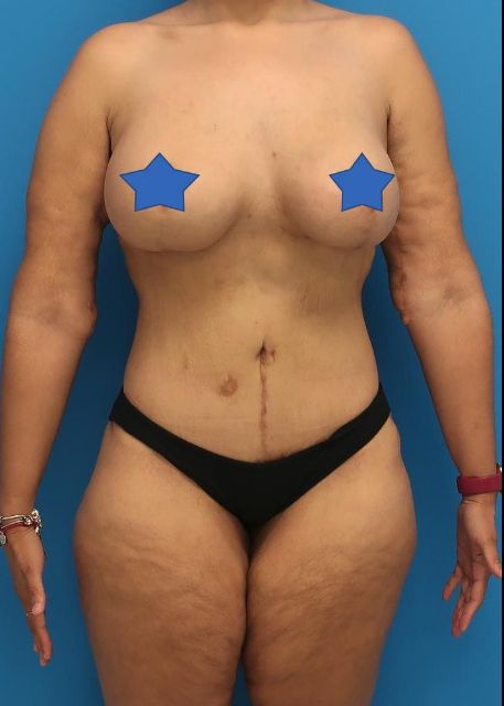 after Brazilian butt lift female patient front view case 3053