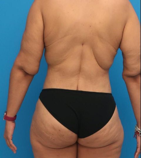 after liposuction female patient back view case 3039
