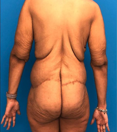 before liposuction female patient back view case 3039