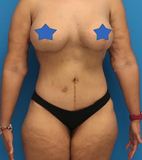 after liposuction female patient front view case 3039