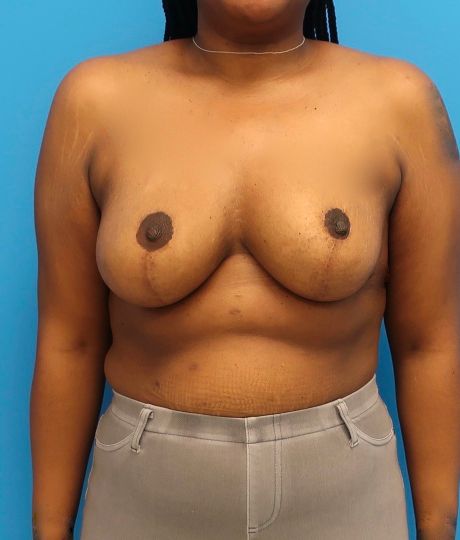 after breast reduction front view case 3104