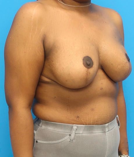 after breast reduction right angle view case 3104
