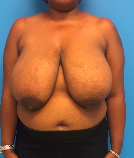 before breast reduction front view case 3104