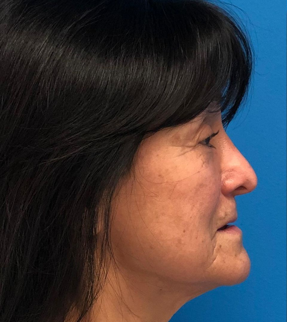 before silhouette instalift female patient right side view case 3097
