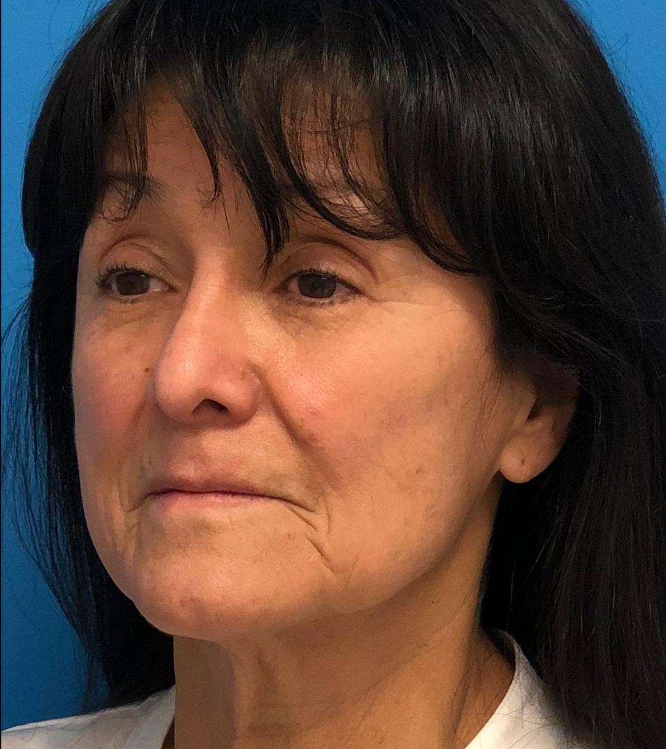 before silhouette instalift female patient left angle view case 3097